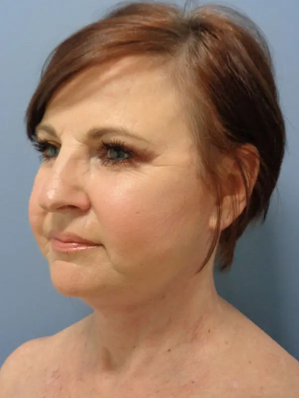 Facelift Before and After Pictures Nashville, TN