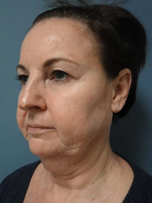 Facelift Before and After Pictures Nashville, TN