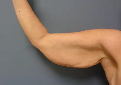 Arm Lift Before and After Pictures Nashville, TN
