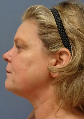 Facelift Before and After Pictures Nashville, TN