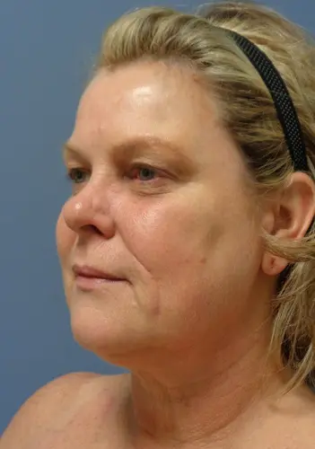 Facelift Before and After Pictures Nashville, TN