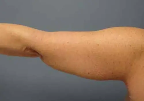 Arm Lift Before and After Pictures Nashville, TN