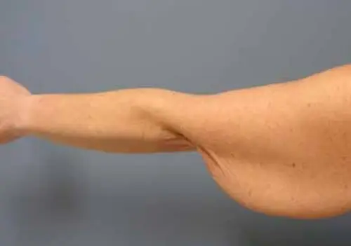 Arm Lift Before and After Pictures Nashville, TN