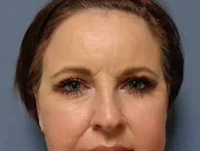 Blepharoplasty Before and After Pictures Nashville, TN