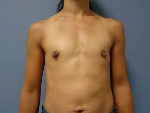 Breast Augmentation Before & After Pictures in Nashville, TN