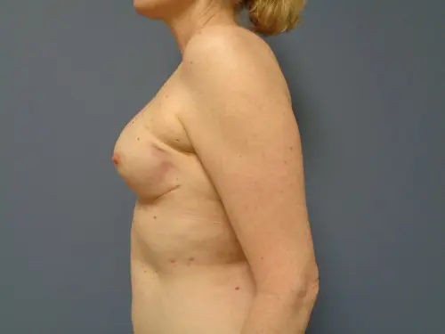 Breast Reconstruction Before and After Pictures Nashville, TN