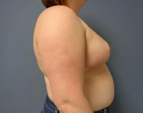 Breast Reduction Before and After Pictures Nashville, TN