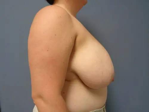 Breast Reduction Before and After Pictures Nashville, TN