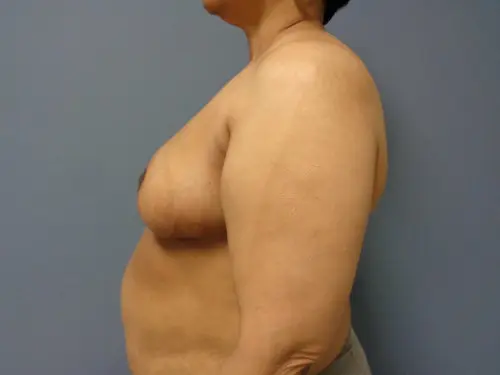 Breast Reduction Before and After Pictures Nashville, TN