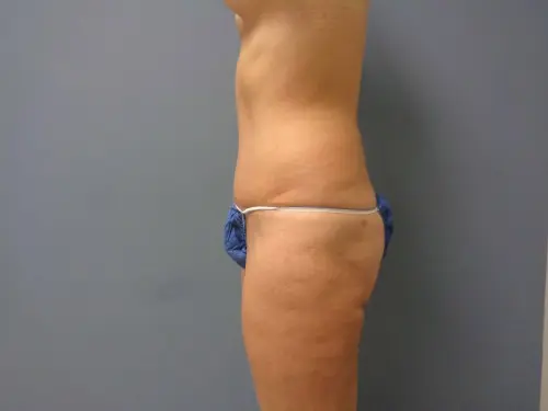 Tummy Tuck Before and After Pictures Nashville, TN