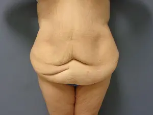 Body Lift Before and After Pictures Nashville, TN