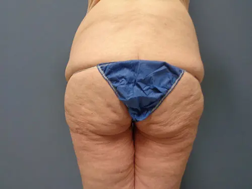 Thigh Lift Before and After Pictures Nashville, TN