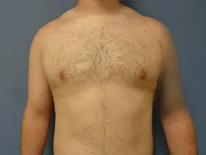Gynecomastia Before and After Pictures Nashville, TN