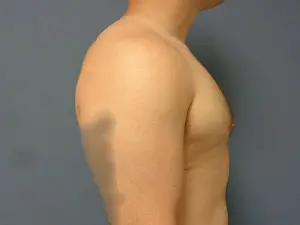 Gynecomastia Before and After Pictures Nashville, TN