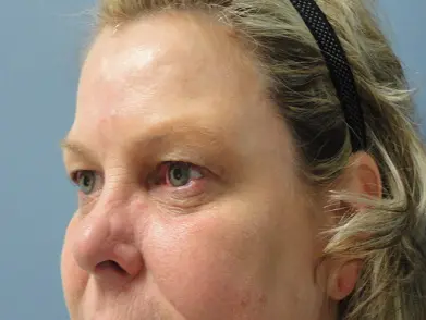 Blepharoplasty Before and After Pictures Nashville, TN