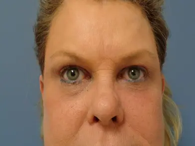 Blepharoplasty Before and After Pictures Nashville, TN