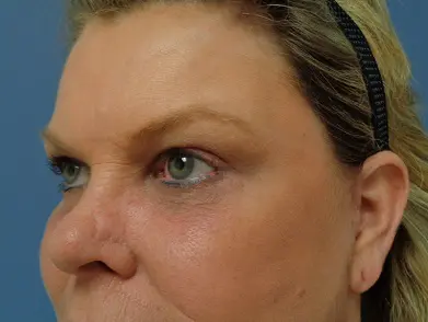 Blepharoplasty Before and After Pictures Nashville, TN