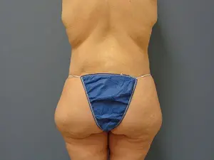 Body Lift Before and After Pictures Nashville, TN