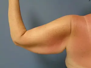 Arm Lift Before and After Pictures Nashville, TN