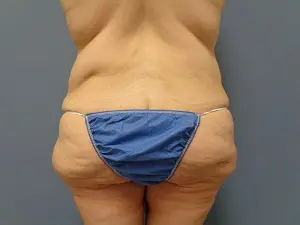 Body Lift Before and After Pictures Nashville, TN