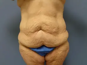 Body Lift Before and After Pictures Nashville, TN