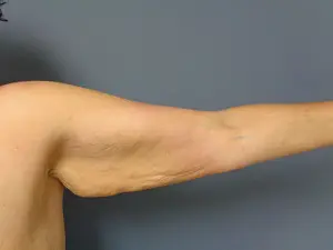 Arm Lift Before and After Pictures Nashville, TN