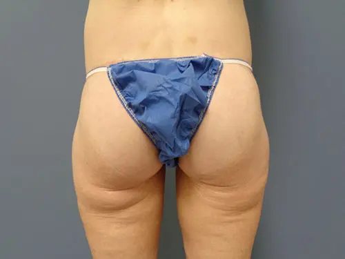 Butt Augmentation Before and After Pictures Nashville, TN