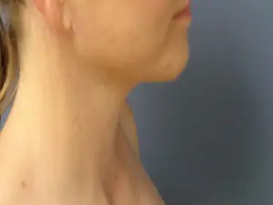 Neck Lift Before and After Pictures Nashville, TN