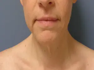 Neck Lift Before and After Pictures Nashville, TN