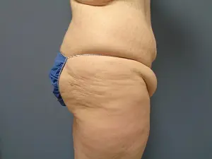 Butt Augmentation Before and After Pictures Nashville, TN
