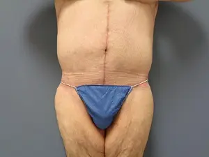 Body Lift Before and After Pictures Nashville, TN