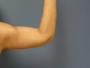 Arm Lift Before and After Pictures Nashville, TN