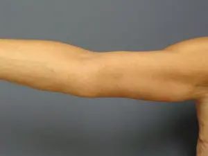 Arm Lift Before and After Pictures Nashville, TN