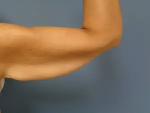 Arm Lift Before and After Pictures Nashville, TN