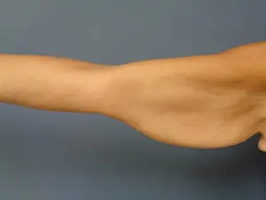 Arm Lift Before and After Pictures Nashville, TN