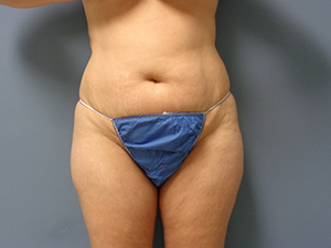 Mommy Makeover Before and After Pictures Nashville, TN