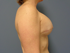 Breast Augmentation Before and After Pictures Nashville, TN