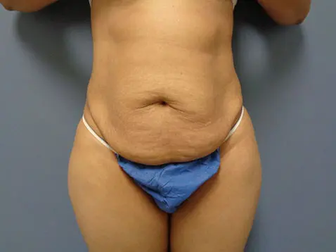 Tummy Tuck Before and After Pictures Nashville, TN