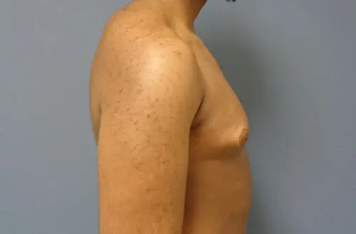 Gynecomastia Before and After Pictures Nashville, TN