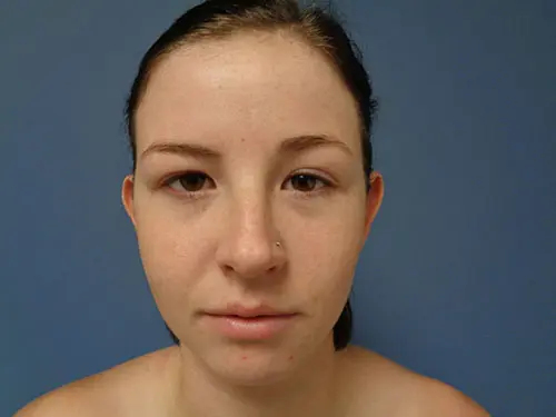 Otoplasty Before and After Pictures Nashville, TN