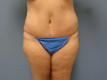 Tummy Tuck Before and After Pictures Nashville, TN