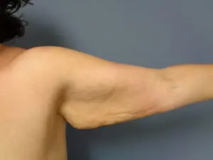 Arm Lift Before and After Pictures Nashville, TN