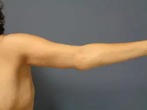 Arm Lift Before and After Pictures Nashville, TN