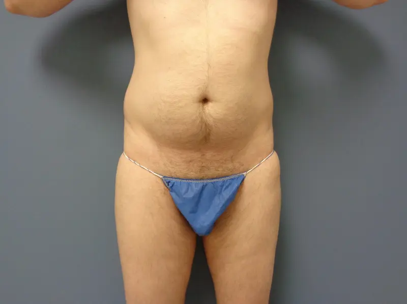 Liposuction Before and After Pictures Nashville, TN