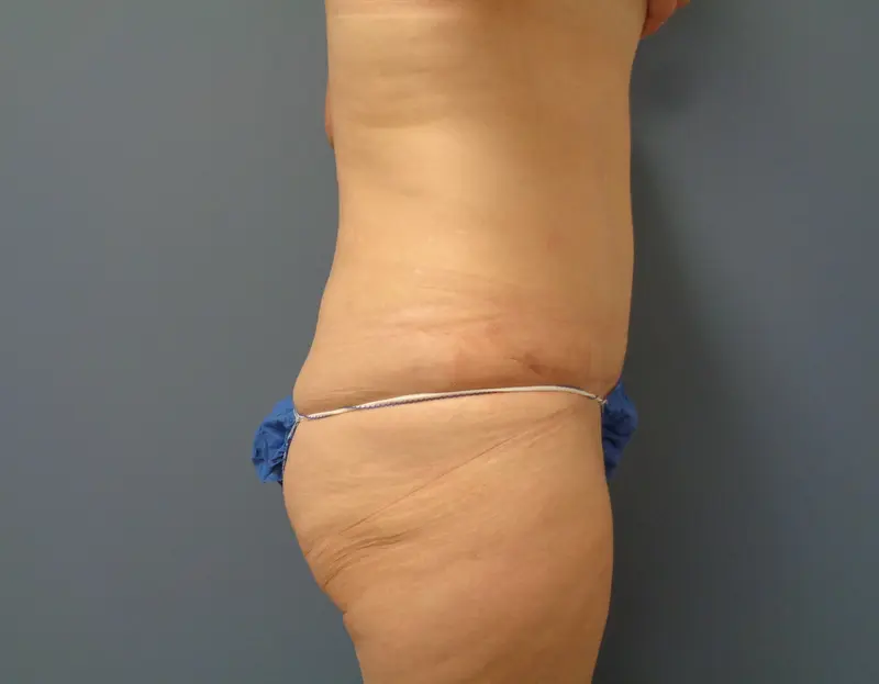 Tummy Tuck Before and After Pictures Nashville, TN