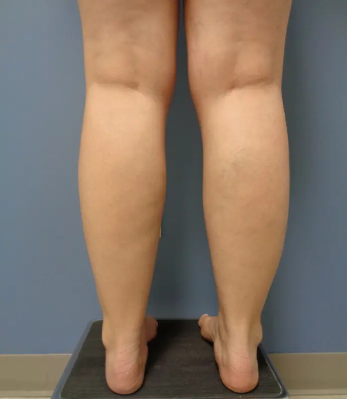 Liposuction Before and After Pictures Nashville, TN