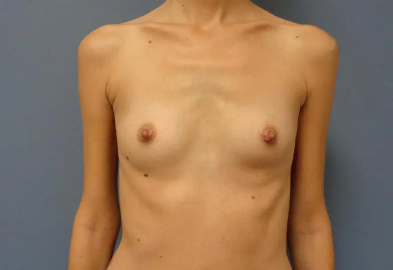Breast Augmentation Before and After Pictures Nashville, TN