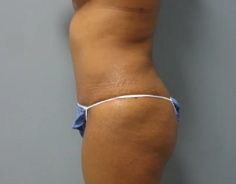 Tummy Tuck Before and After Pictures Nashville, TN