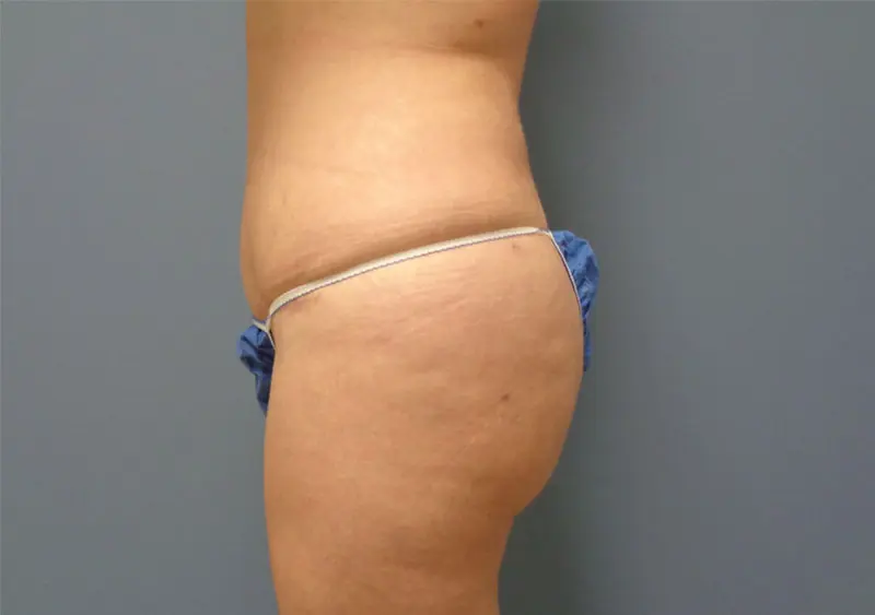 Butt Augmentation Before and After Pictures Nashville, TN