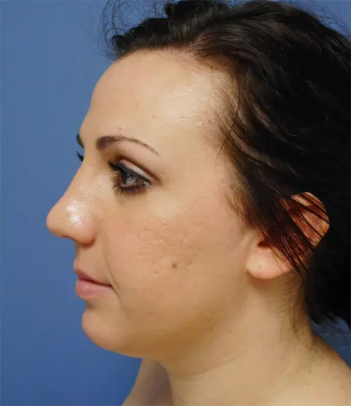 Rhinoplasty Before & After Pictures in Nashville, TN